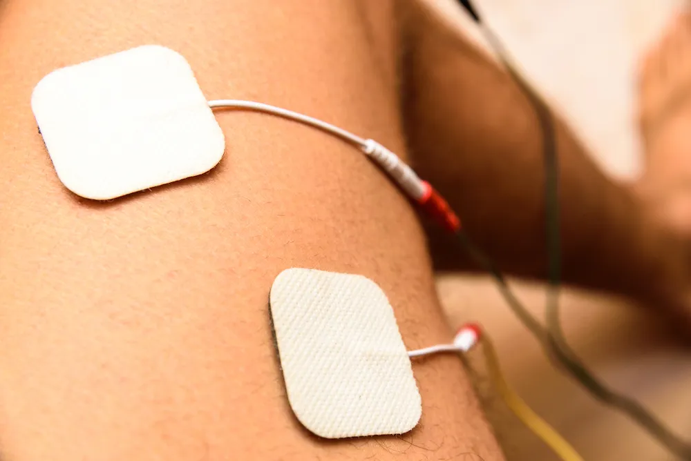 Two electrotherapy electrode pads attached to a person's upper arm