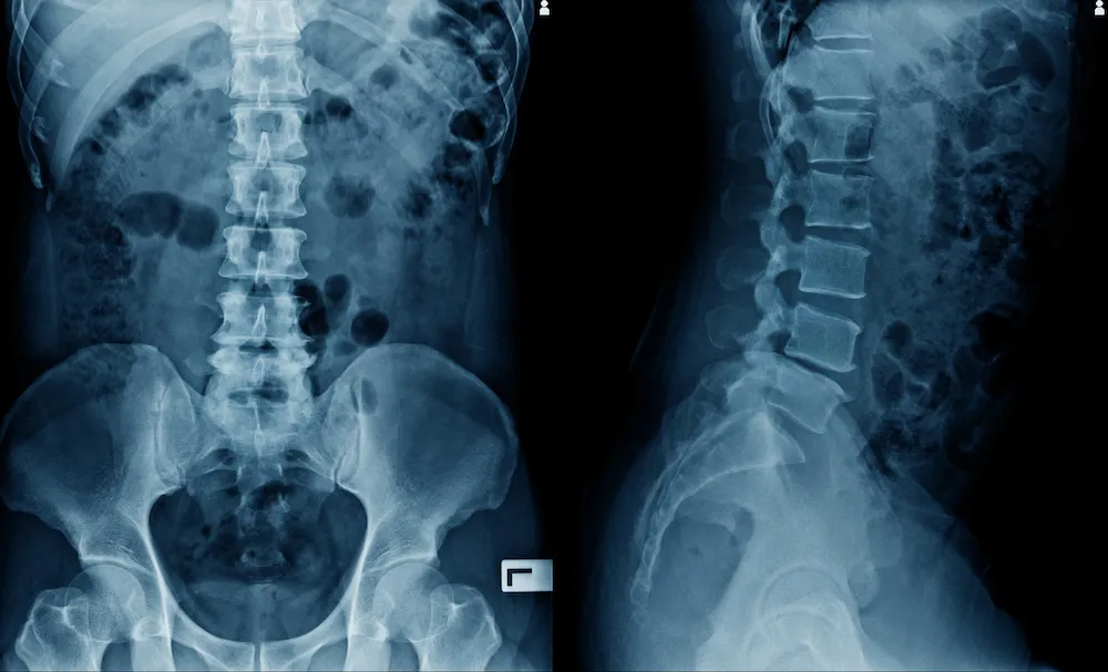 Front and side X-ray views of the lower spine and pelvis