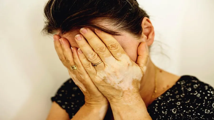 Tired woman with vitiligo patches on her hands covering her face